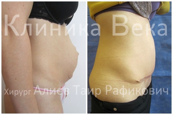 Абдоминопластика и герниопластика