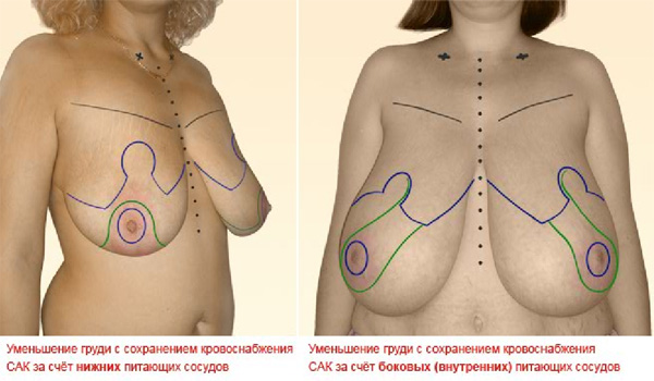 Уменьшение груди (редукционная маммопластика)