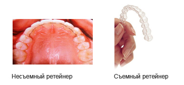 Несъемный ретейнер и съемный ретейнер